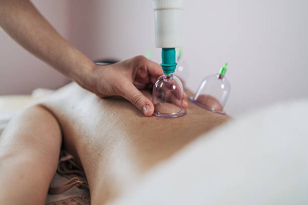 Close-up of a therapist's hands skillfully placing suction cups on a patient's back, administering cupping therapy for pain relief and improved well-being